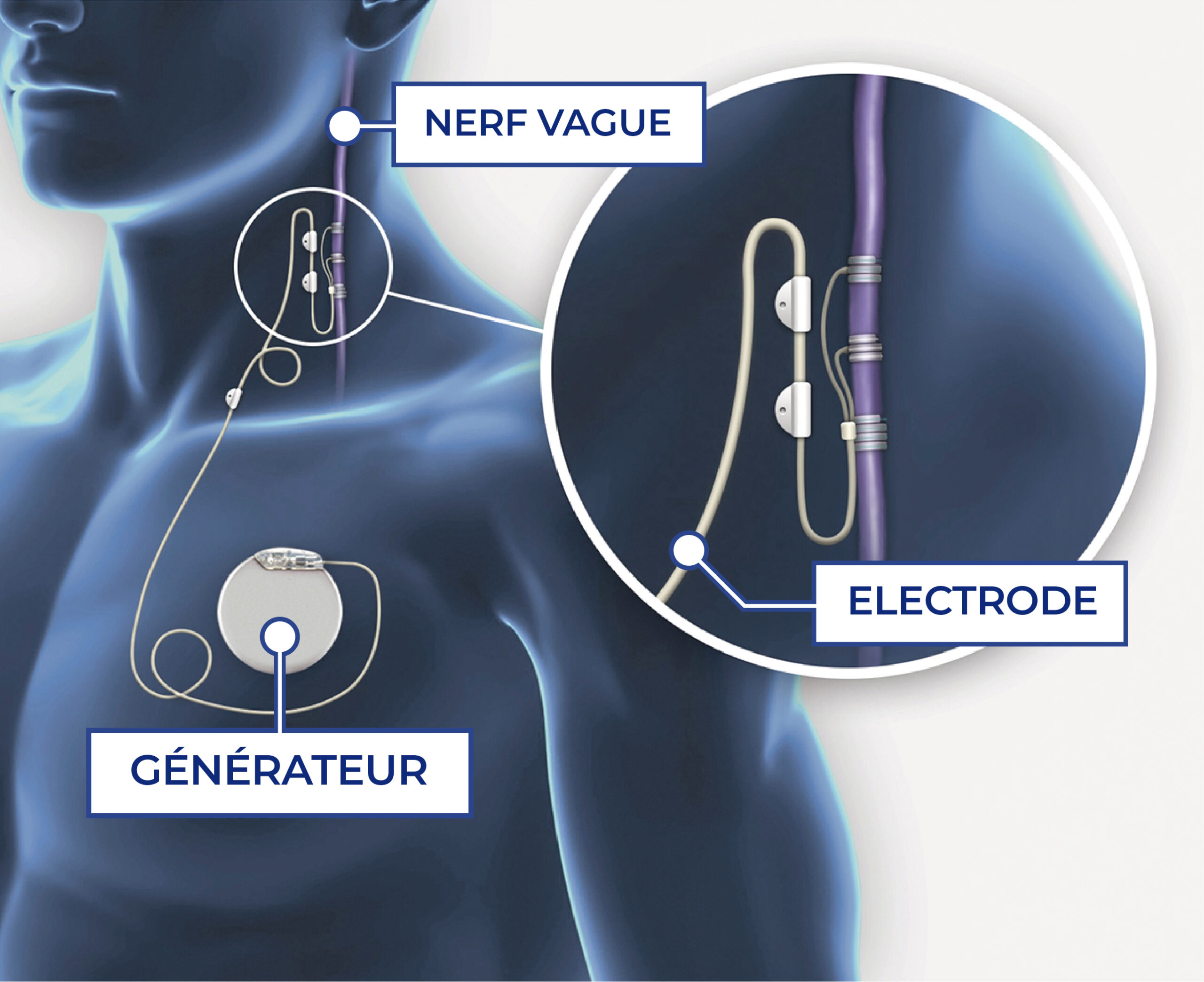 Neurostimulation vagale (NSV) pour les MICI : Afa Crohn RCh